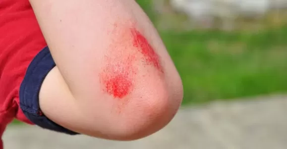 Applications of Hydrogel Dressing