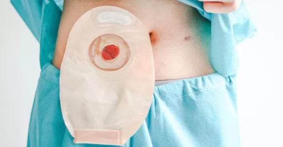 applicable population of ostomy bag