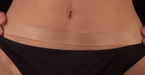 clinical applications of silicone scar sheet