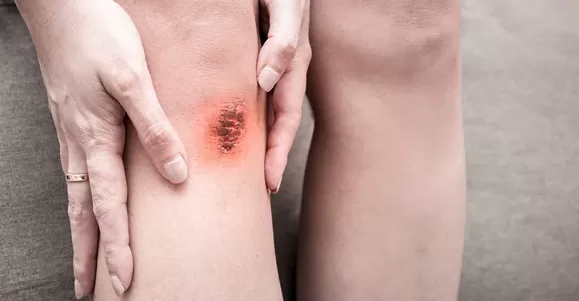 Applications of Hydrogel Dressing