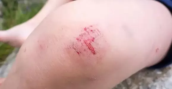 first aid backpack empty