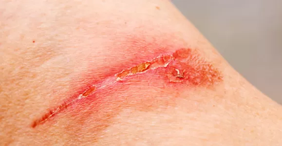 Indications of High Absorption Dressing Indications of High Absorption Dressing