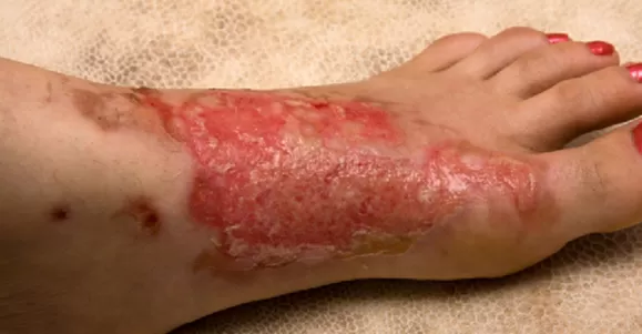 Indications of High Absorption Dressing Indications of High Absorption Dressing