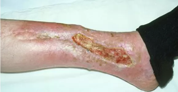 Indications of High Absorption Dressing Indications of High Absorption Dressing