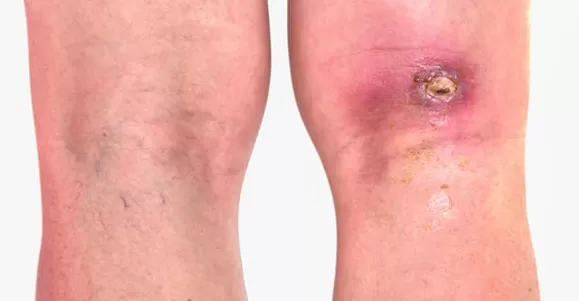 Application of Hydrocolloid Dressing