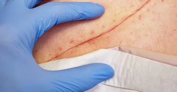 Application of Hydrocolloid Dressing