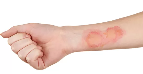 Application of Hydrocolloid Dressing