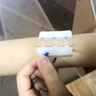 hydrocolloid-wound-closure-device-10.jpg