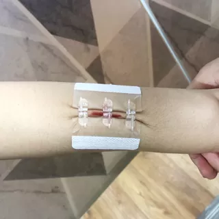 hydrocolloid-wound-closure-device-11.jpg hydrocolloid-wound-closure-device-11.jpg