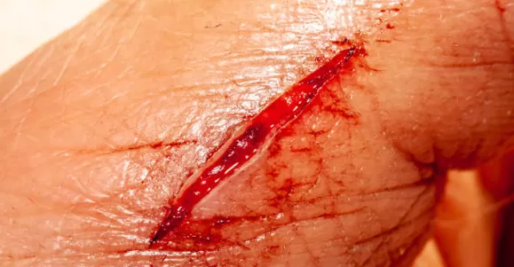 hydrocolloid wound closure device types