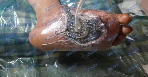 Indications of NPWT Dressing