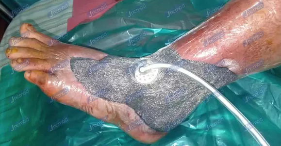 Indications of NPWT Dressing