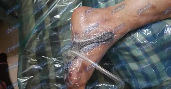 Indications of NPWT Dressing