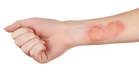 Applications of Hydrogel Dressing