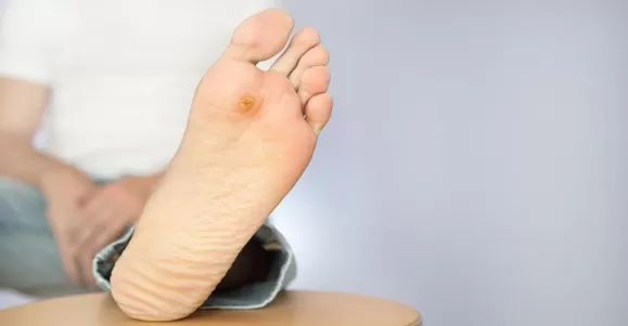 Indication of PHMB Dressing