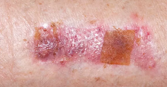 Indication of PHMB Dressing