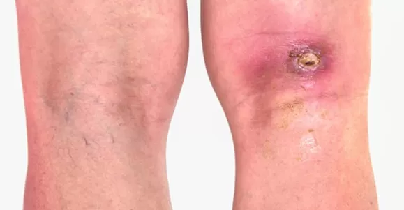 Indication of PHMB Dressing