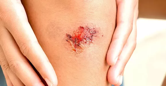 Indication of PHMB Dressing