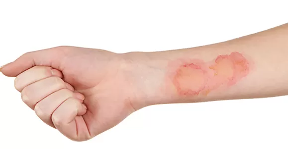 Indication of PHMB Dressing