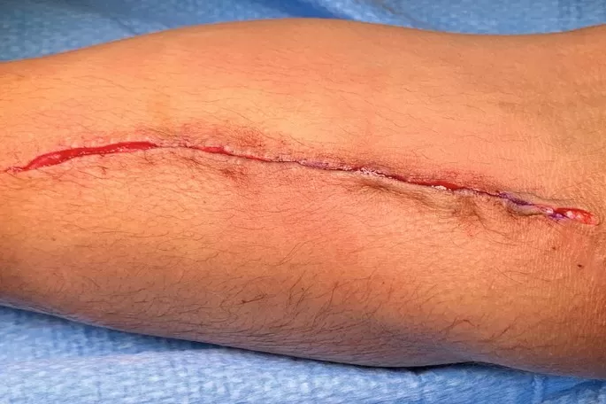 postoperative exudative wounds.jpg