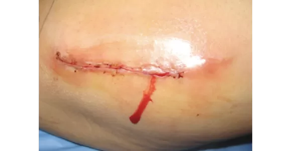 Applications of Silver Dressing