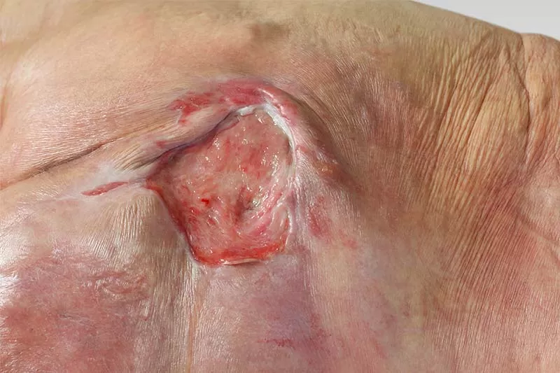 pressure sores.jpg