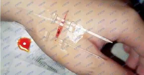 pu film wound closure device kinds