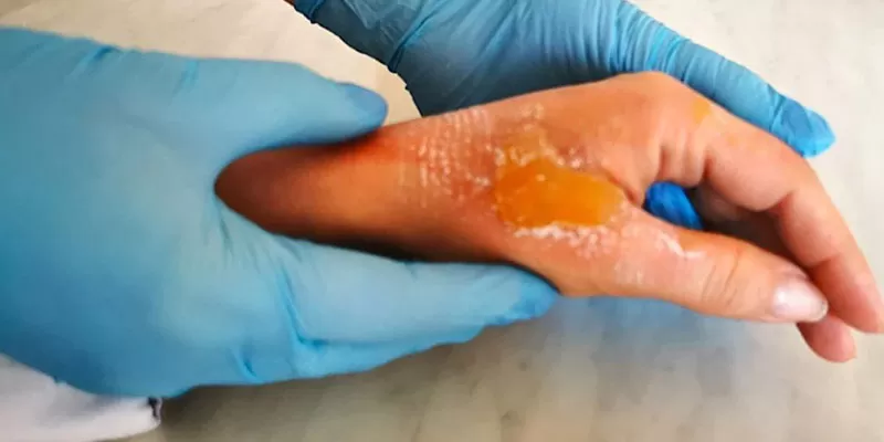 I-Il degree burns and scalds