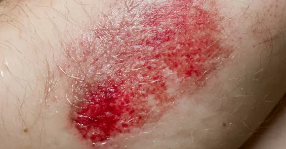 silicone contact layer oem