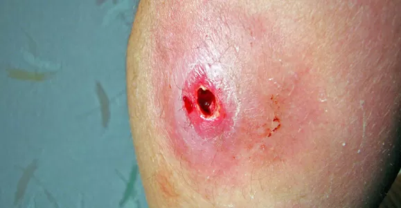 Applications of Hydrogel Dressing