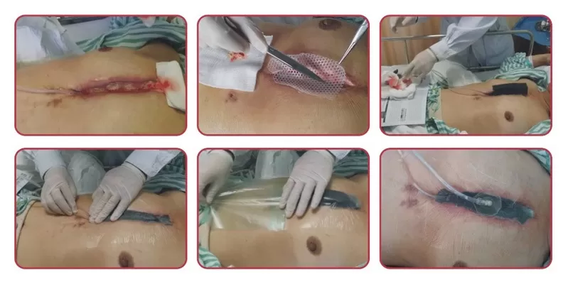 Spets of Using NPWT Dressing