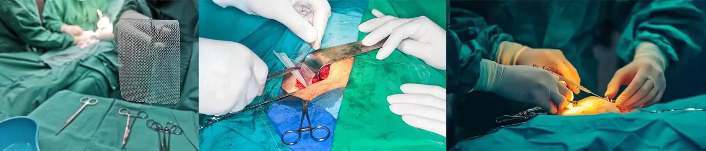 Steps for Using a Surgical Mesh