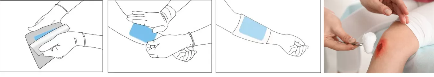 Steps of Using Alginate Dressing