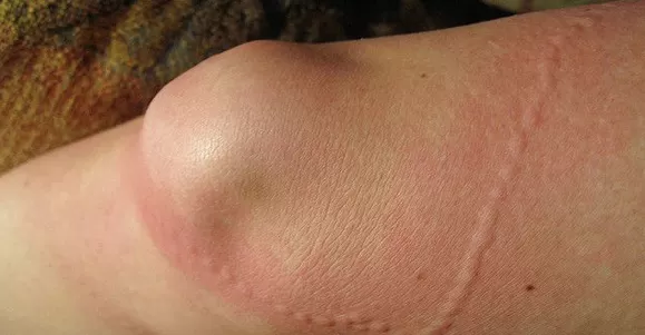 surgical tape bandage