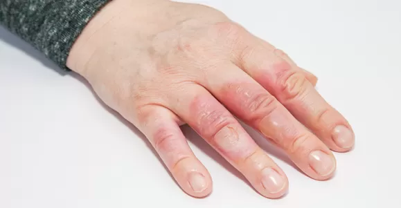 vaseline gauze dressing factory