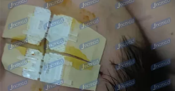 wound closure device company