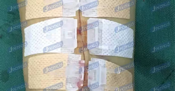 wound closure device use