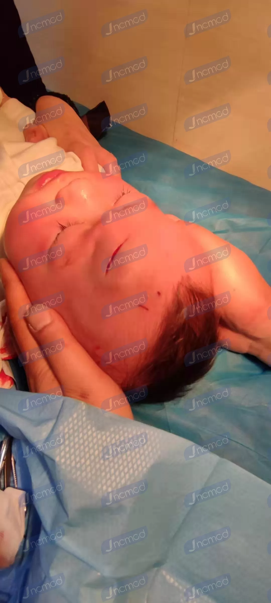 wound closure device.jpg