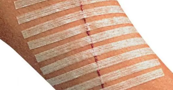 wound closure strips odm