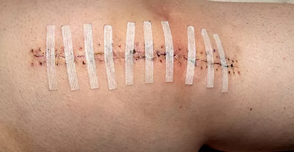 wound closure strips oem